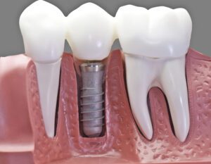 Implante dentário - TJSC - Santa Catarina - Indenização