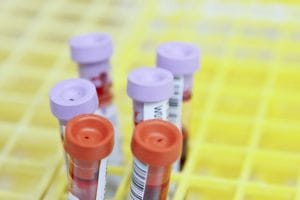 SUS passa a oferecer teste para rastreamento do câncer colorretal em pessoas de 50 a 75 anos | Juristas
